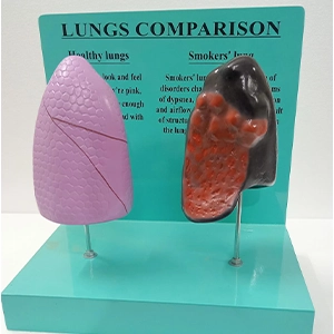Lungs Comparison Model (Healthy vs Diseased Lung)